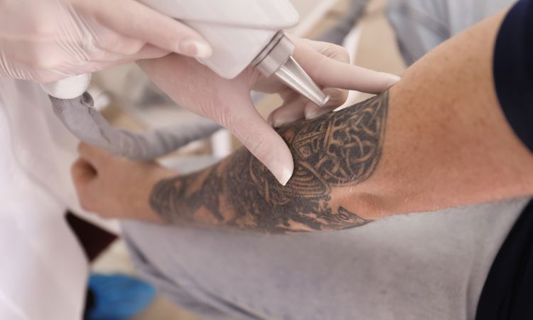 Descubre el borrado de tatuajes y cómo es el proceso